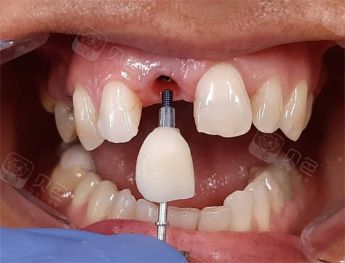 上海罗缘口腔门牙种植