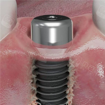 种植体骨结合横截面图