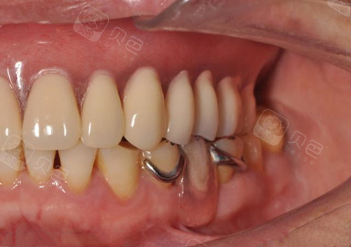 种半口牙好还是戴半口假牙好种植牙和假牙优缺点详解