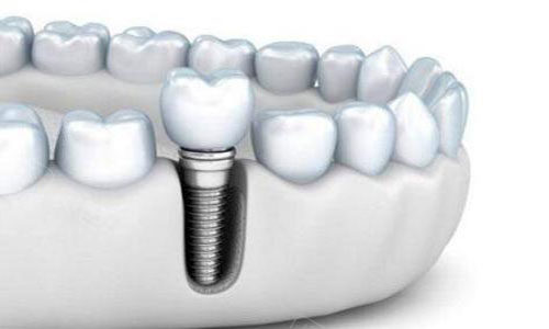 在乌鲁木齐给老年人种植牙,有哪些不错的口腔医院? - 贝色口腔