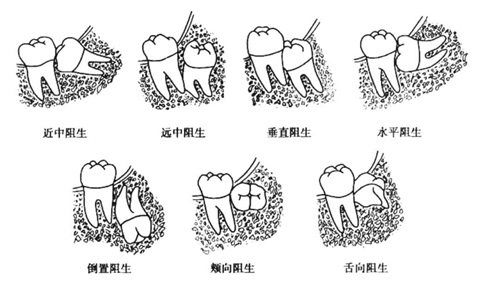 不同阻生智齿示意图
