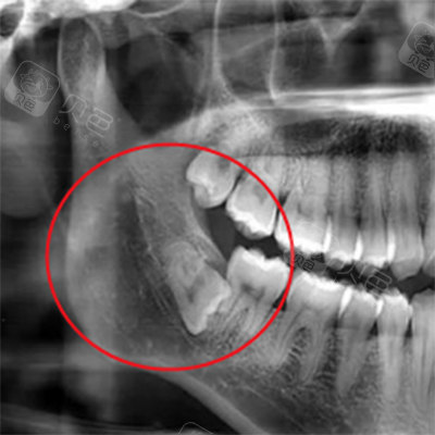 埋伏阻生智齿ct图展示