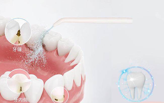 喷啥洁牙比普通洁牙多了一个步骤,就是使用特制的盐砂和高压水为牙齿