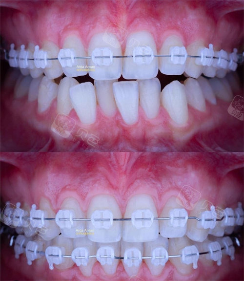 上海陶瓷托槽矫正图片