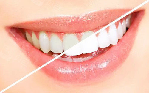 牙齿美白对比图