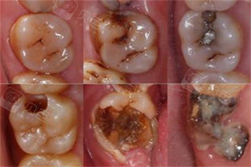 补牙过程图