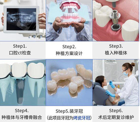 种植牙的流程