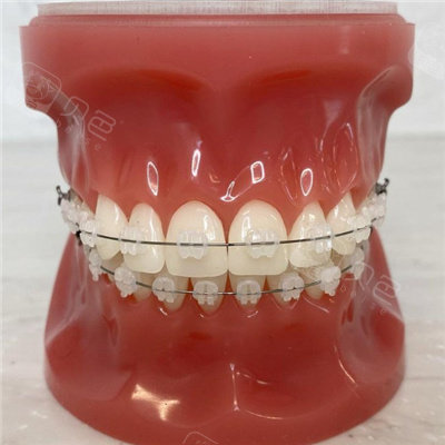 牙套妹分享广州半隐形矫正多少钱内附各品牌牙套参考价格