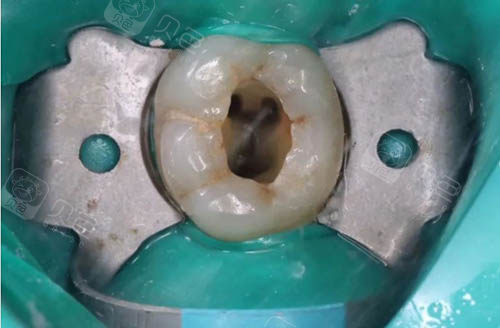 根管治疗4次哪次最痛?坚持不住的话可以吃止疼药吗?