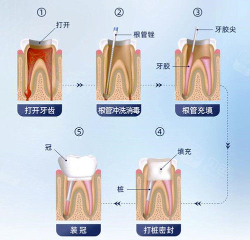 纠结烤瓷牙和全瓷牙哪个好一点分享亲身经历教你怎么选择