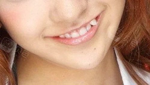 虎牙矫正要多少钱虎牙需要矫正牙齿吗利弊分析在此