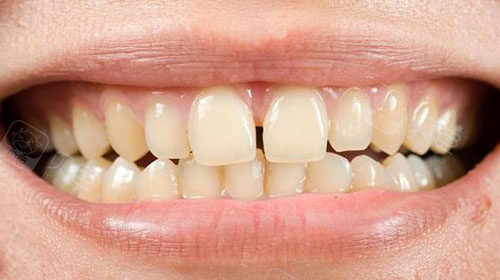 门牙中间有缝在新疆能做牙齿矫正吗