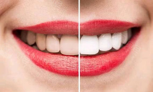 新疆牙齿美白贴面价格是多少分享新疆牙贴面好的医院