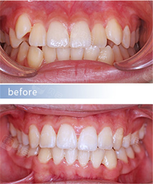 儿童反颌矫正对比