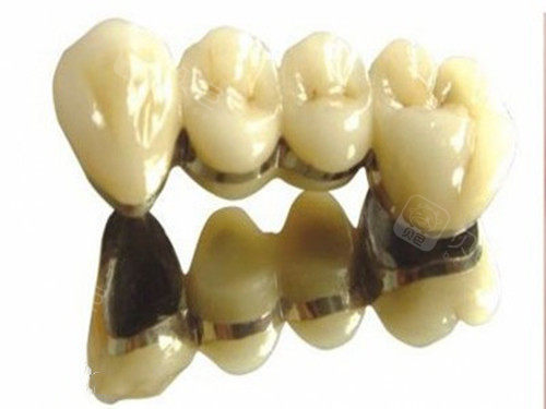 哈尔滨美中口腔的种植牙套餐咋样牙冠用钴铬材料好不好