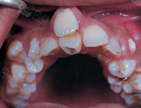 昆明小孩牙齿矫正多少钱群里宝妈说很贵大概要10000元