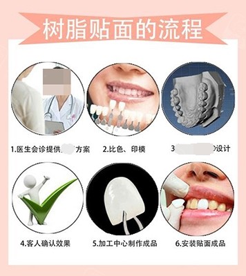 价格篇两分钟带你了解南宁牙齿贴面大概多少钱一颗