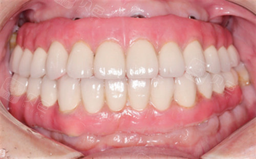 在做完全口牙齿种植后总共花费了:65000元初次之外,还有一个要说下,就