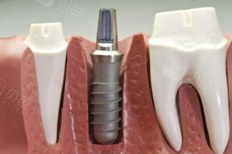 终于在上海私立口腔医院把种植牙做了一般一颗3500元起