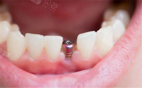 上海瑞伢美口腔种植牙示意图