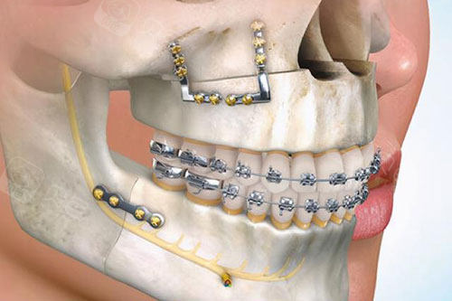 正颌正畸联合治疗示意图