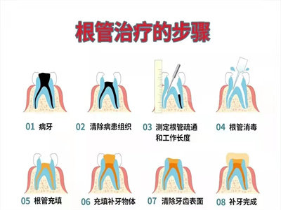 根管治疗的牙齿两年后又痛了别过于迷信不拔牙治疗