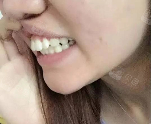 武汉牙齿外凸矫正多少钱?我两万六做时代天使正畸经历分享!