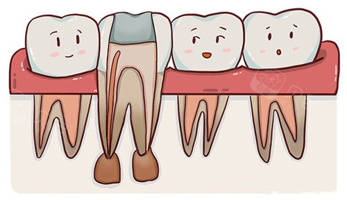 根管治疗好几千都包含什么项目