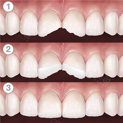 门牙断裂补牙前后对比