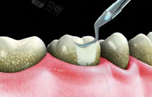 口腔综合治疗参考价格表:超声波洁牙套餐88元起瑞士e-max瓷贴面2800元