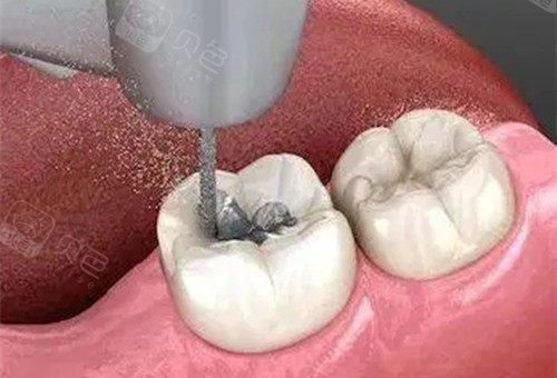 二次补牙需要把洞挖大吗二次补牙为什么超级疼