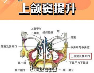 上颌窦脊顶提升技术