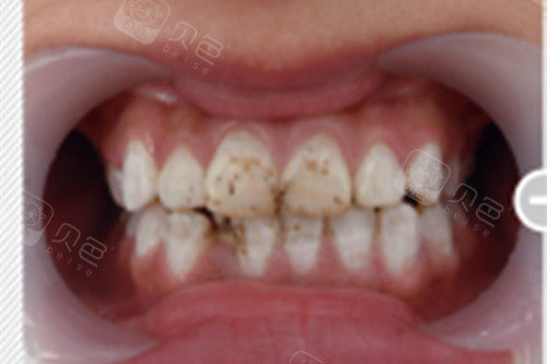 人,作了牙齿瓷贴面之后简直就是毁牙齿,今天就和大家分享一下这个贵州