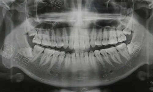 舟山拔智齿多少钱一次网友盘点当地拔牙好的齿科公布