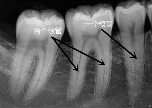 牙齿根管数量