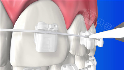 广州整牙多少钱带你了解各类不同牙套整牙费用要多少