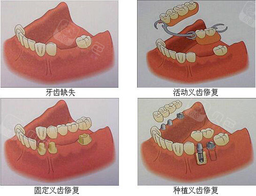 活动义齿和种植牙修复示意图