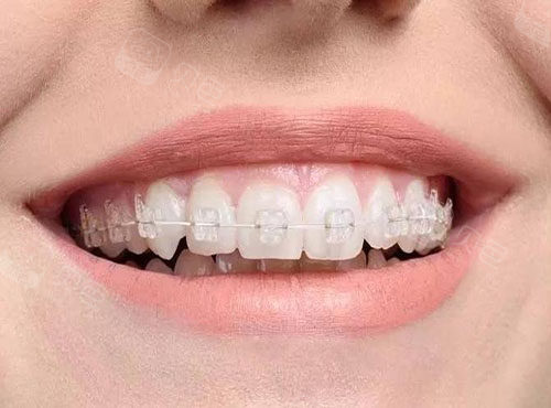 箍牙是一种比较有效将牙齿排列整齐的方法,拥有一口洁白整齐的牙齿