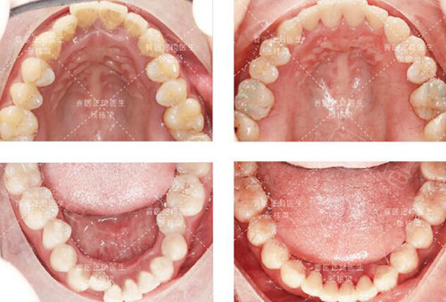 北京禾禾齿科牙齿正畸前后照片