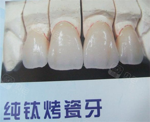 纯钛烤瓷牙