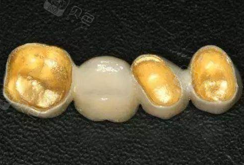 黄金烤瓷牙