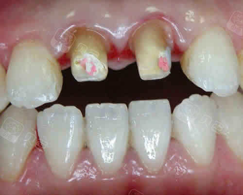 需要做牙冠的牙齿实拍