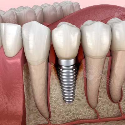 这几个种植牙失败的前兆要警惕! - 贝色口腔