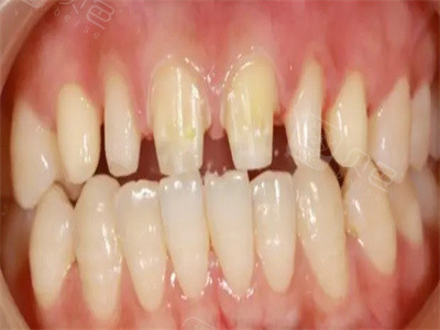 门牙好牙被磨拆除烤瓷牙之后