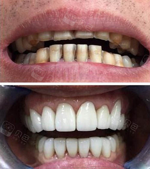 牙齿贴面前后图