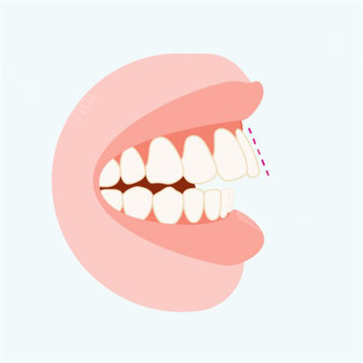 龅牙矫正用牙套有用吗?选择什么牙套适合?