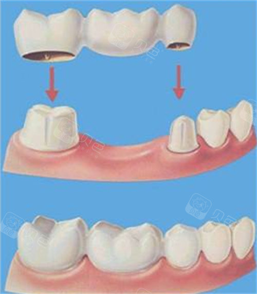 有广东汕头看牙好的医院排名还愁不知道做烤瓷全瓷牙多钱