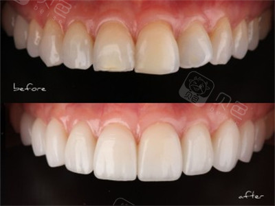 前牙美学瓷贴面前后对比