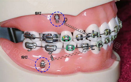 牙齿矫正骨钉支抗钉模型示意图