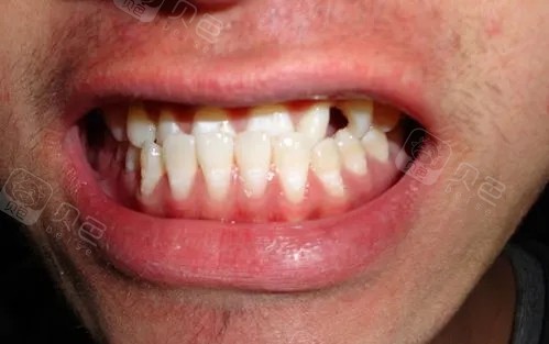 地包天在医学上叫反颌,通常有骨性地包天,齿性地包天及复合性地包天